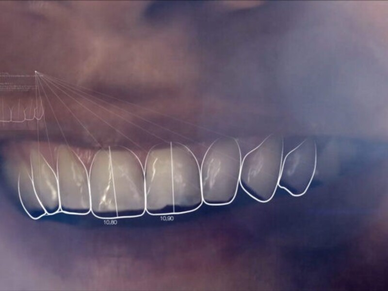 smile makeover in indore, smile designing in Indore